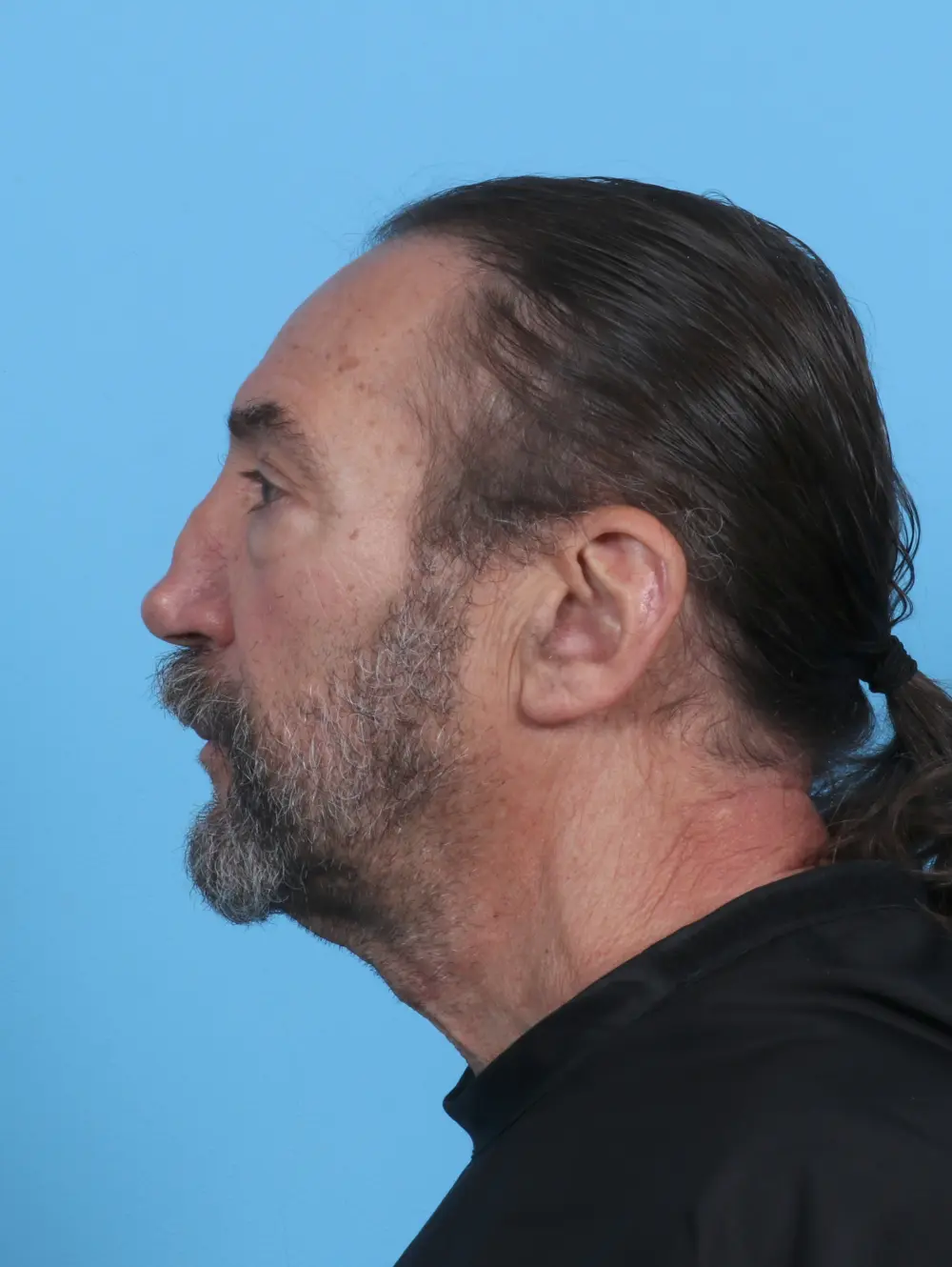 Eyelid Surgery Patient Photo - Case 46886 - before view-2