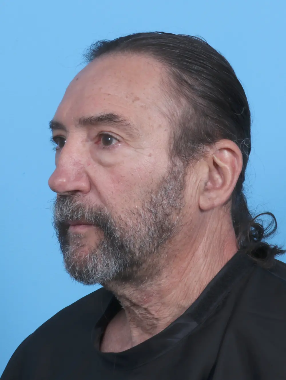 Eyelid Surgery Patient Photo - Case 46886 - before view-1