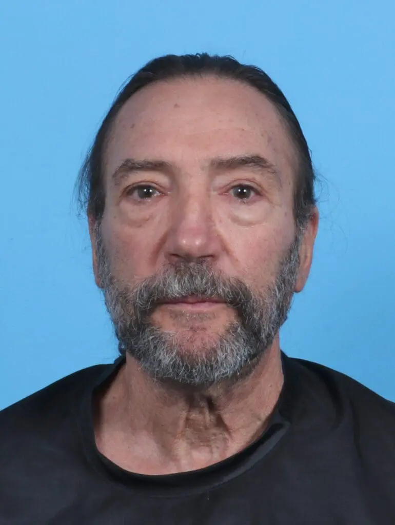 Eyelid Surgery - Case 46886 - Before