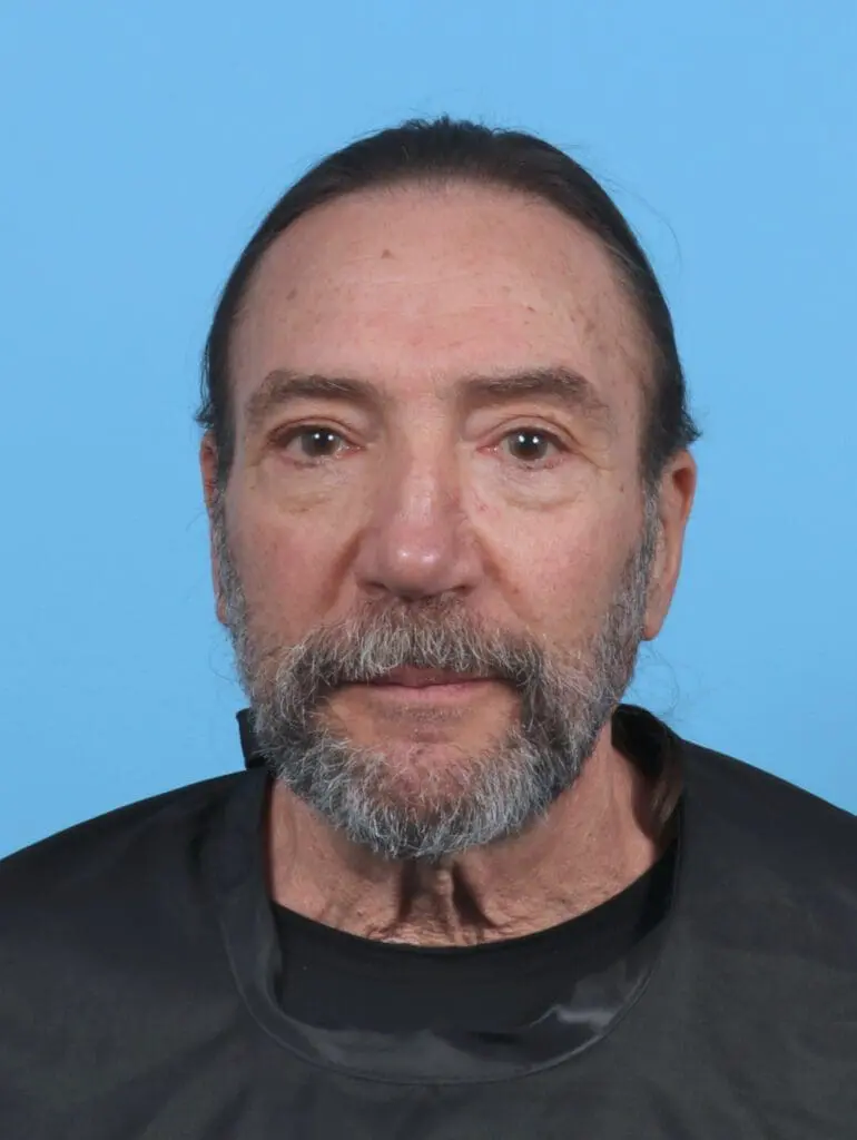 Eyelid Surgery - Case 46886 - After