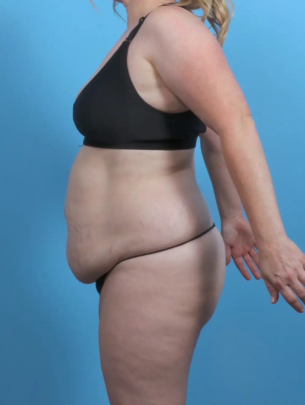 Tummy Tuck Patient Photo - Case 46902 - before view-2