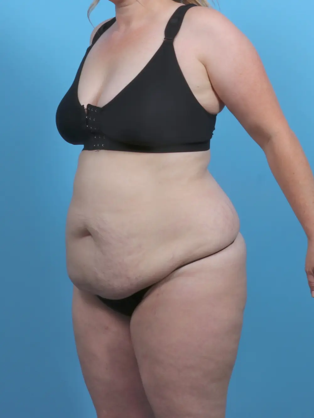 Tummy Tuck Patient Photo - Case 46902 - before view-1