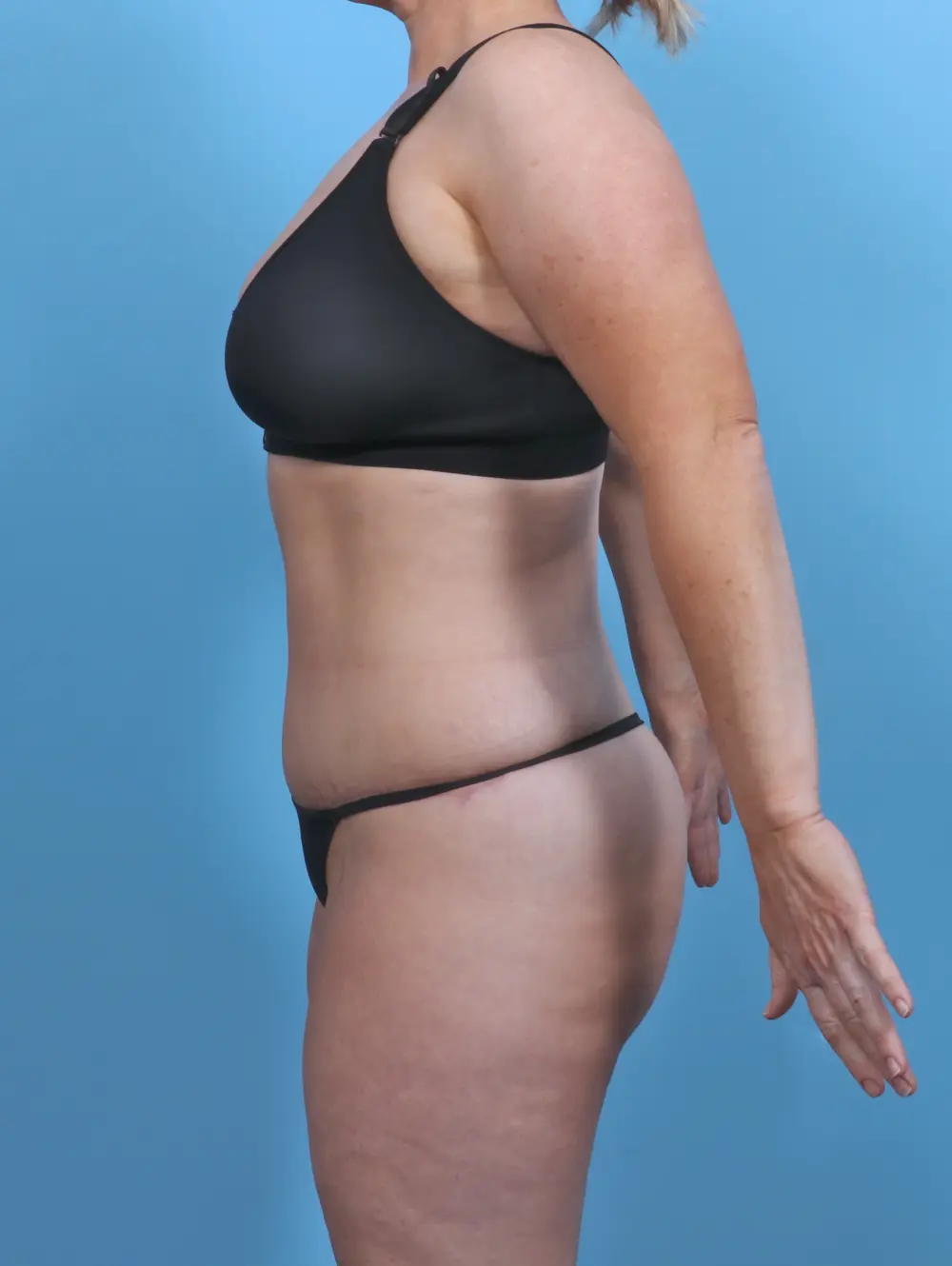 Tummy Tuck Patient Photo - Case 46902 - after view-2