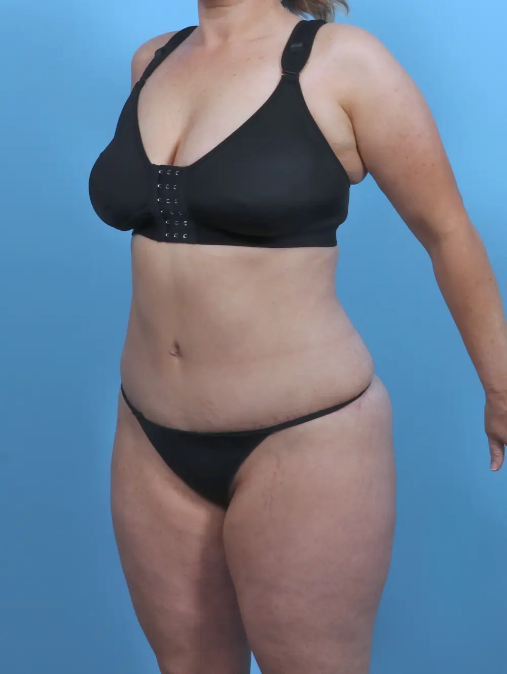 Tummy Tuck Patient Photo - Case 46902 - after view-1