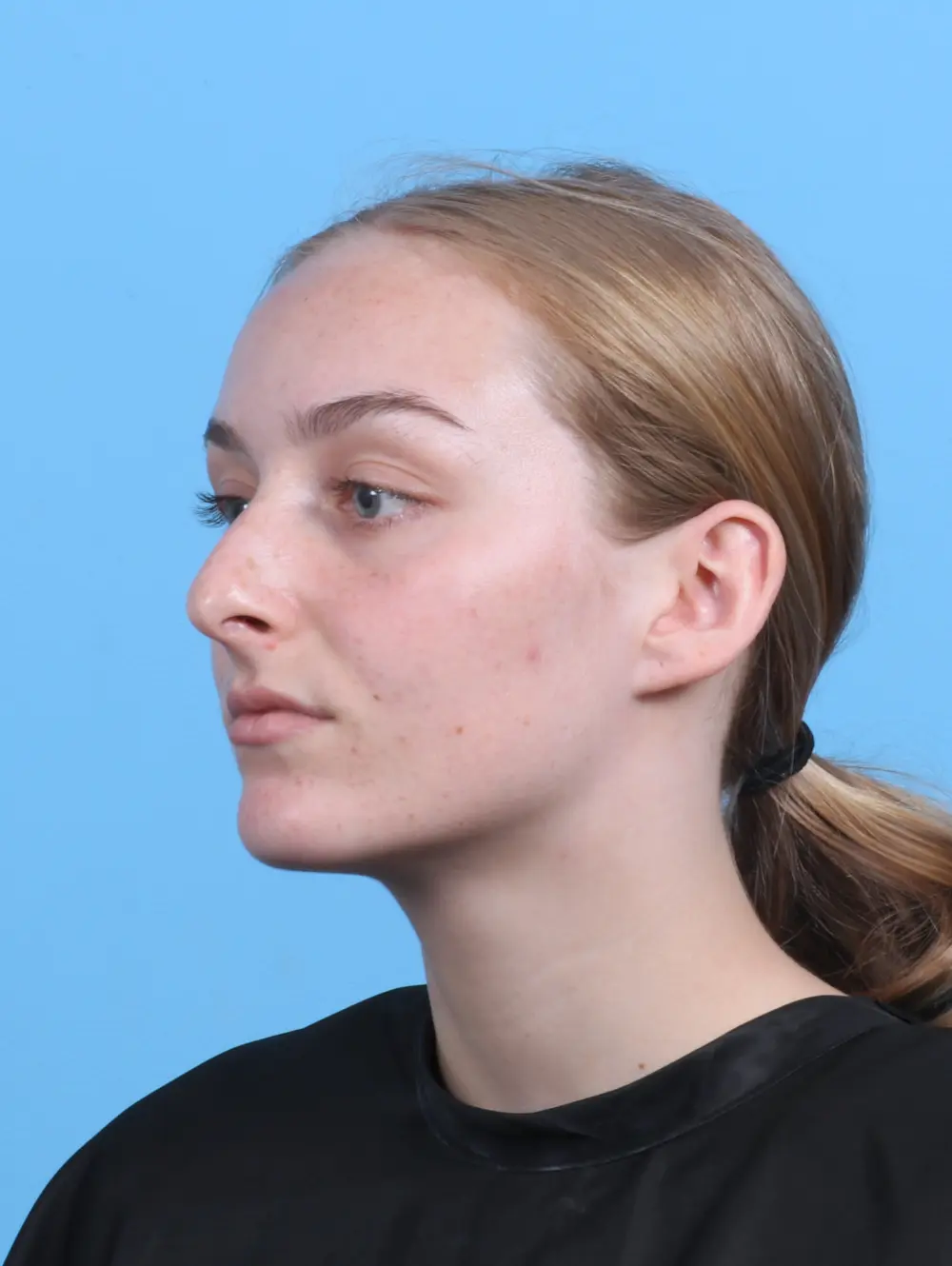 Rhinoplasty Patient Photo - Case 46939 - before view-1