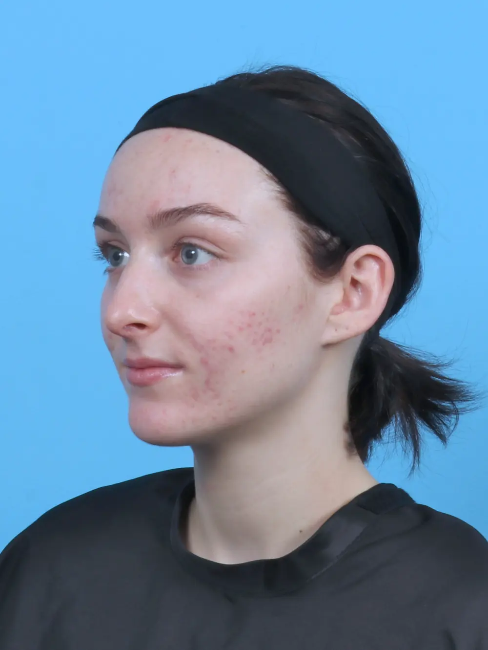 Rhinoplasty Patient Photo - Case 46939 - after view-1