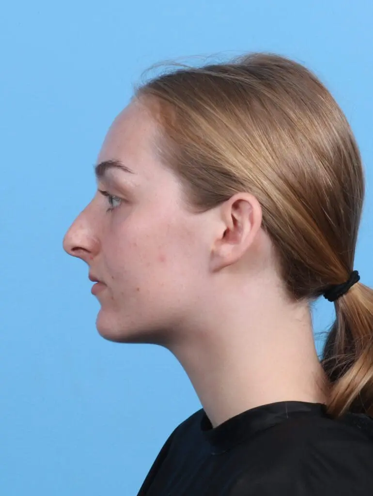 Rhinoplasty - Case 46939 - Before
