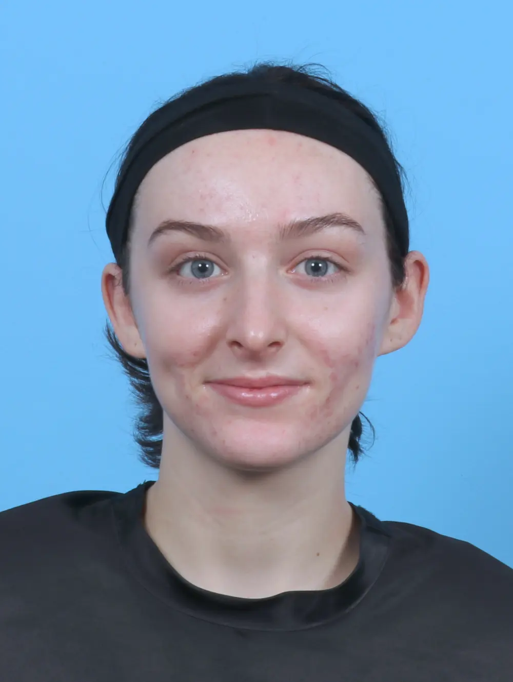 Rhinoplasty Patient Photo - Case 46939 - after view-2