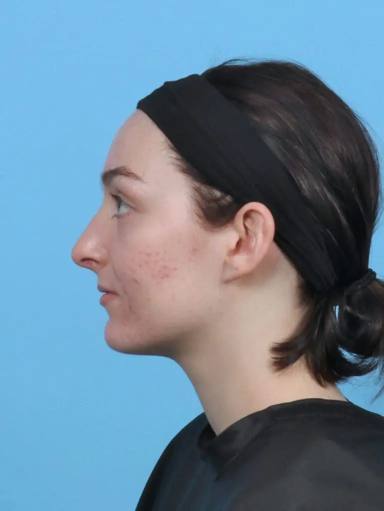 Rhinoplasty - Case 46939 - After