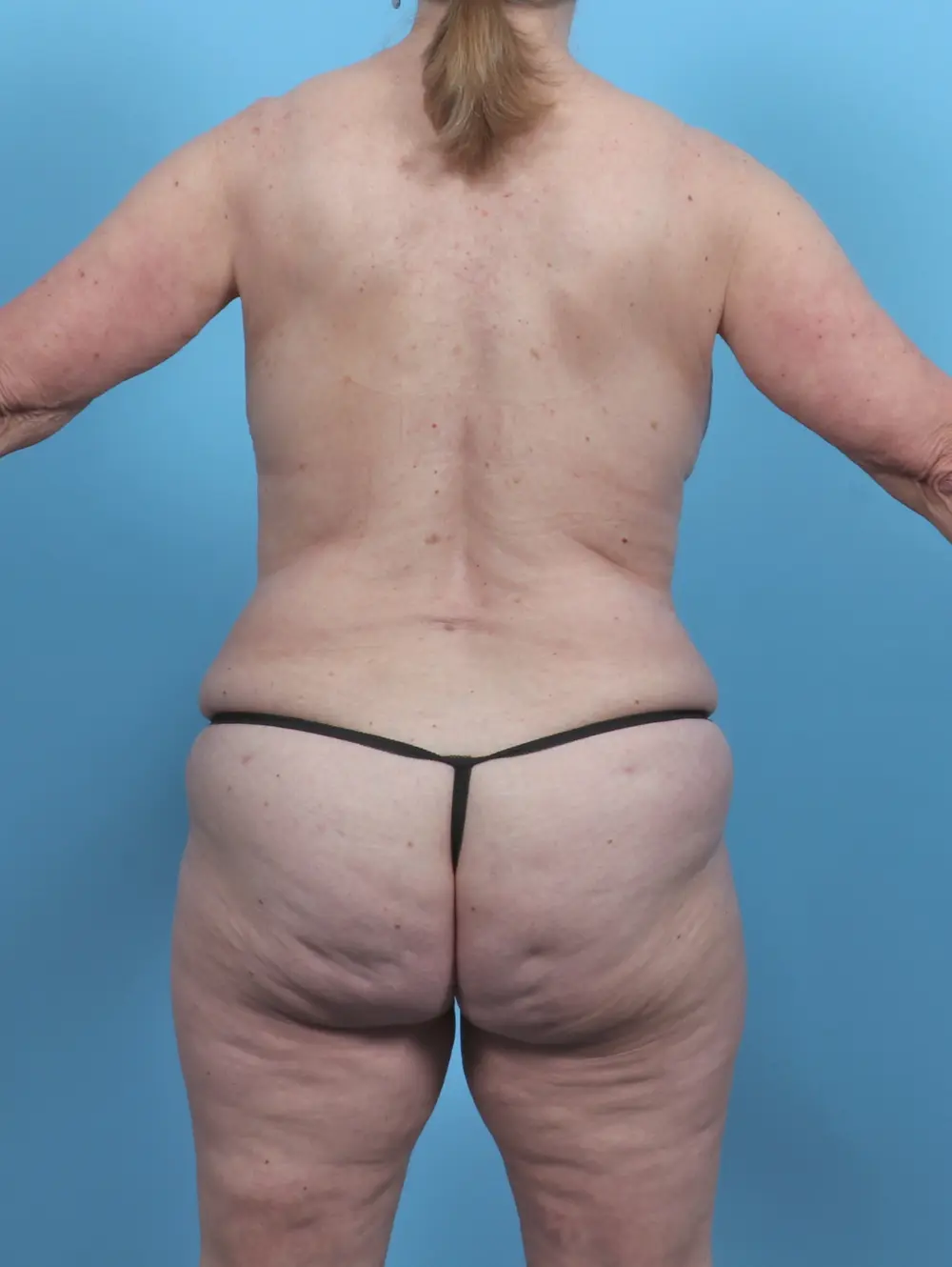 Breast Lift/Reduction with Implants Patient Photo - Case 46993 - after view-3