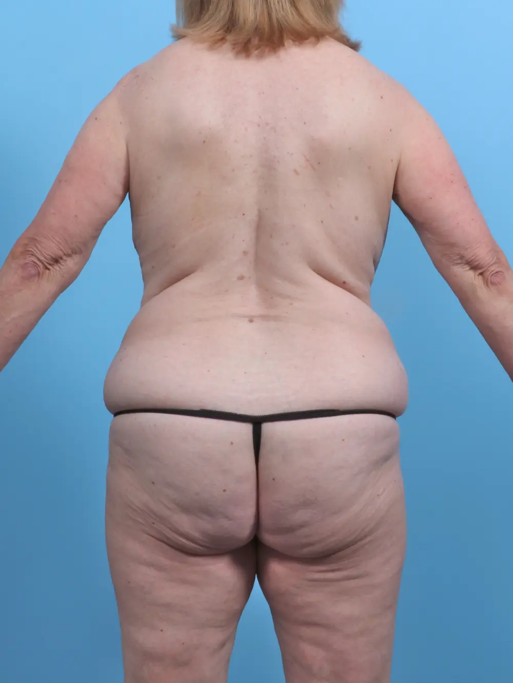 Breast Lift/Reduction with Implants Patient Photo - Case 46993 - before view-3