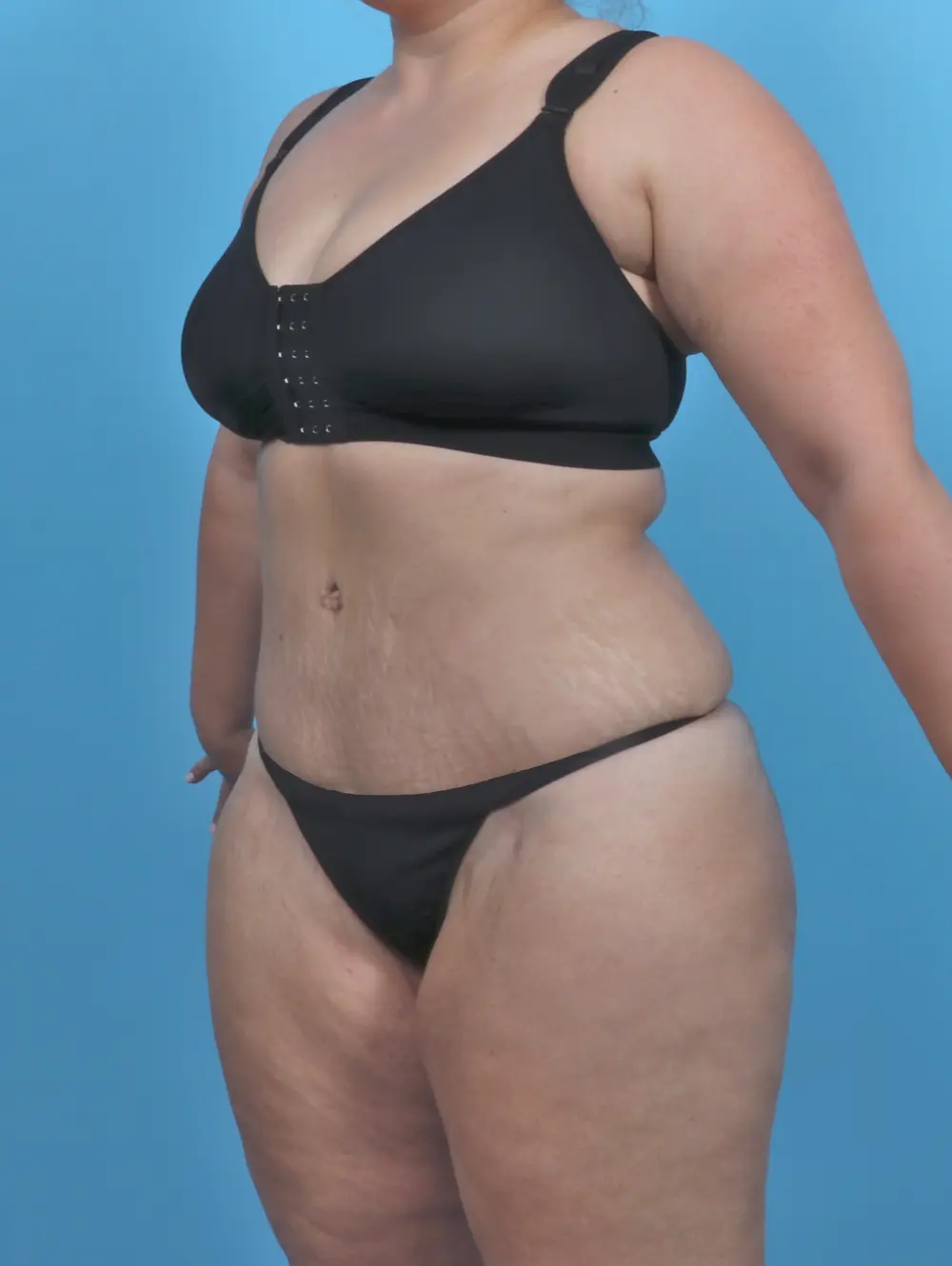 Tummy Tuck Patient Photo - Case 47013 - after view-1
