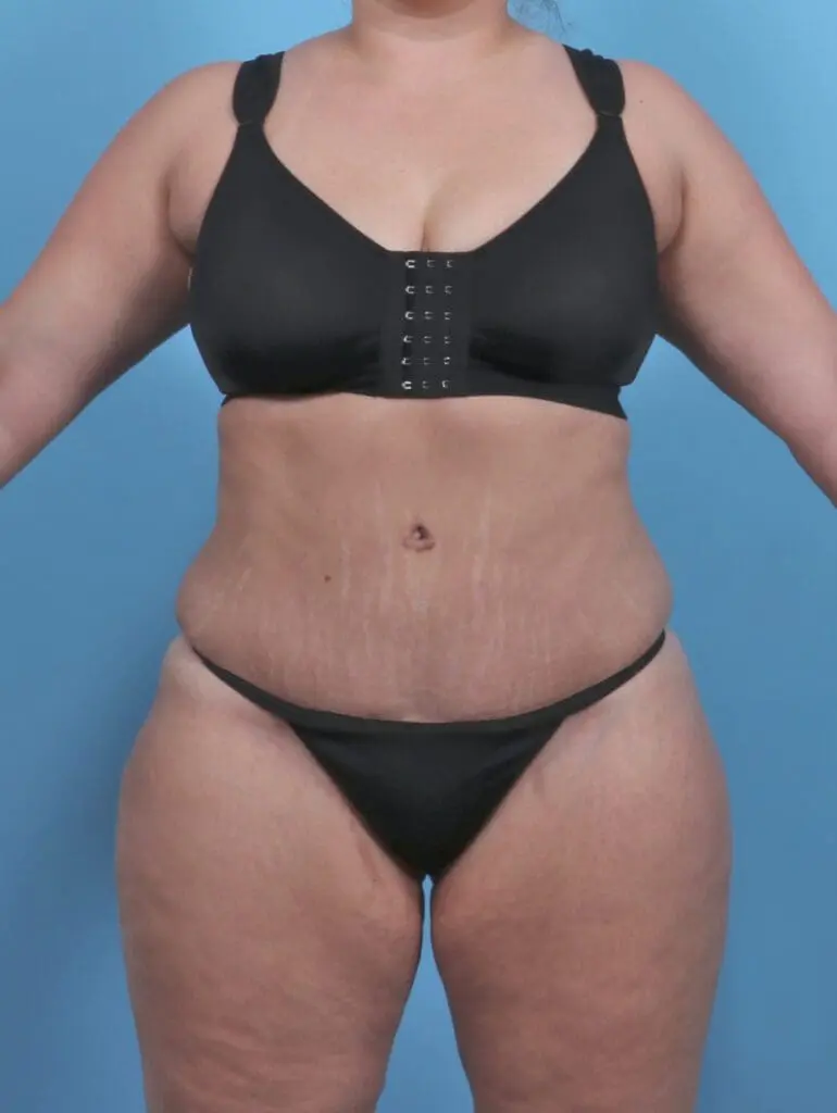 Tummy Tuck - Case 47013 - After