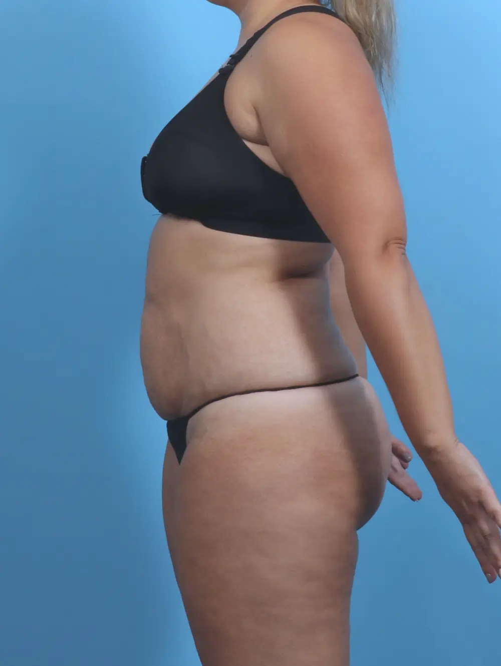 Tummy Tuck Patient Photo - Case 47013 - before view-2