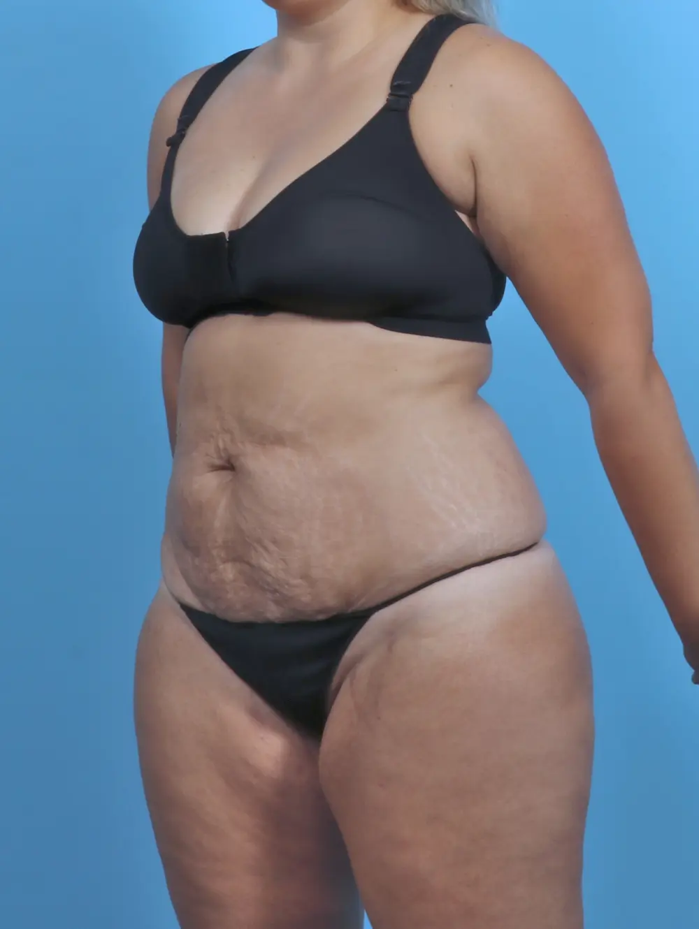 Tummy Tuck Patient Photo - Case 47013 - before view-1