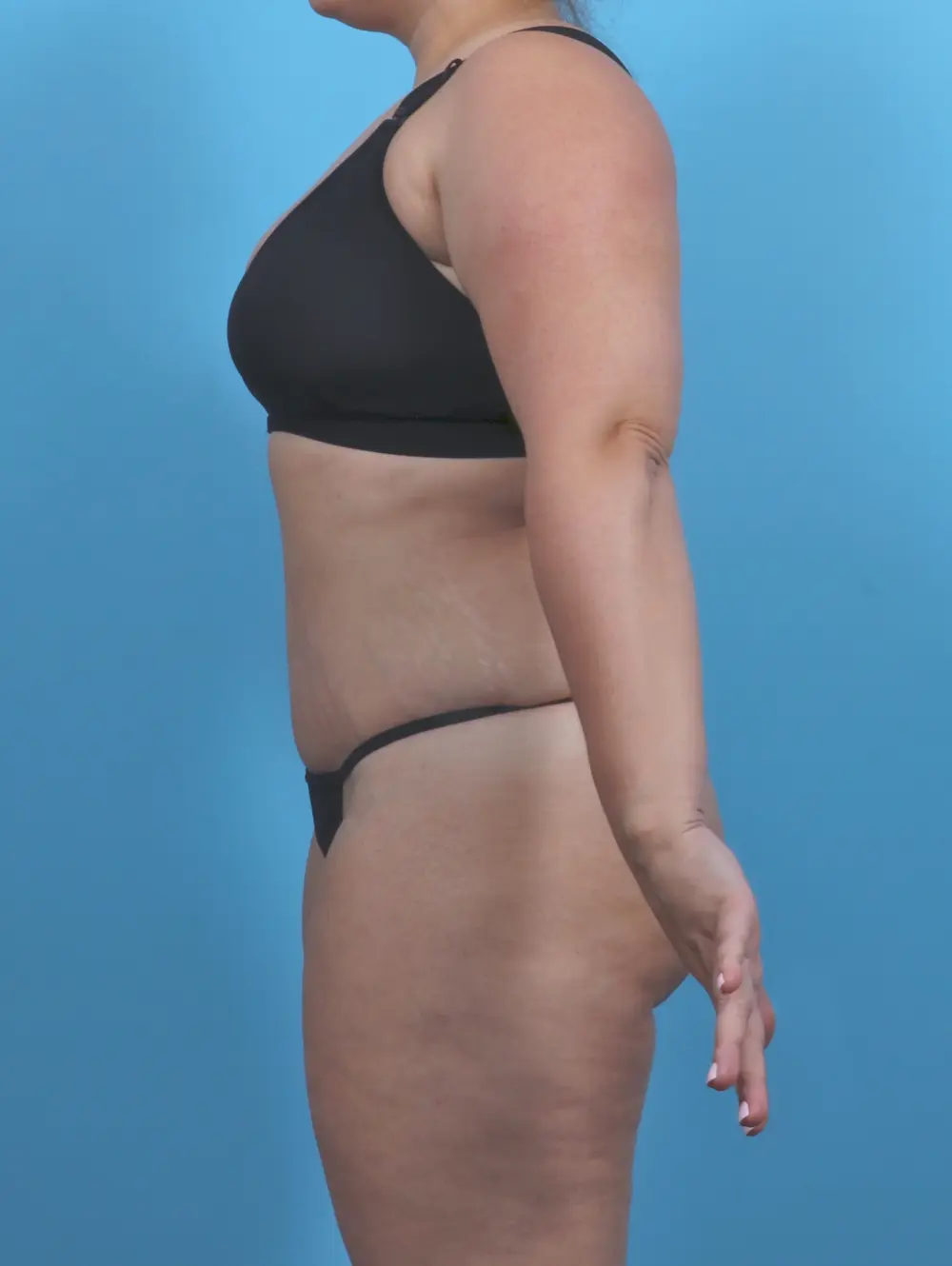 Tummy Tuck Patient Photo - Case 47013 - after view-2