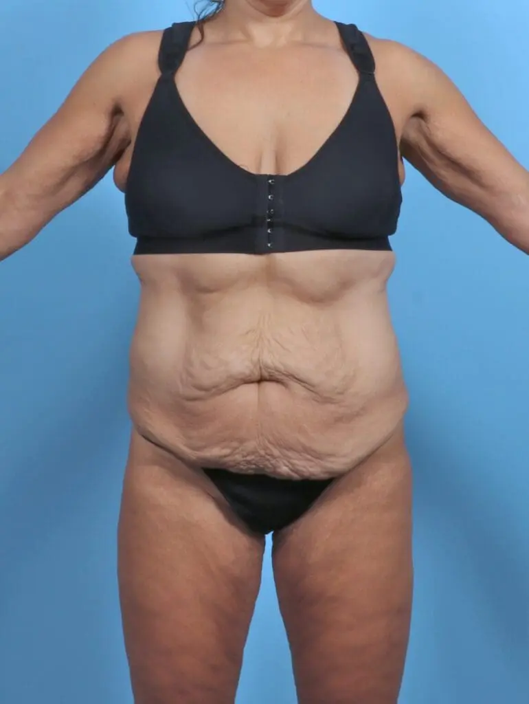 Tummy Tuck - Case 47088 - Before