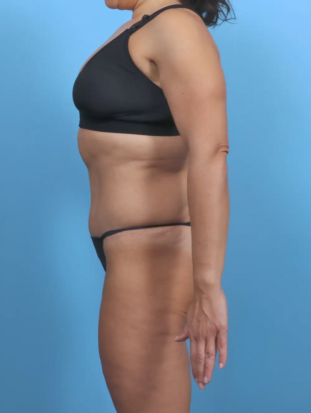 Tummy Tuck Patient Photo - Case 47088 - after view-2