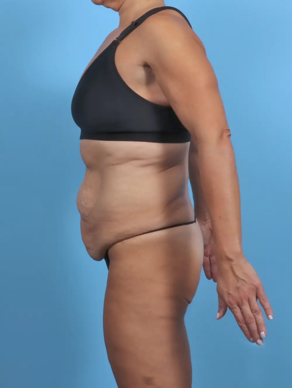Tummy Tuck Patient Photo - Case 47088 - before view-2