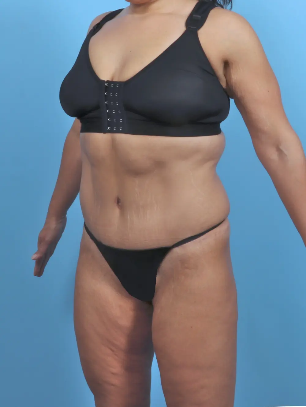 Tummy Tuck Patient Photo - Case 47088 - after view-1