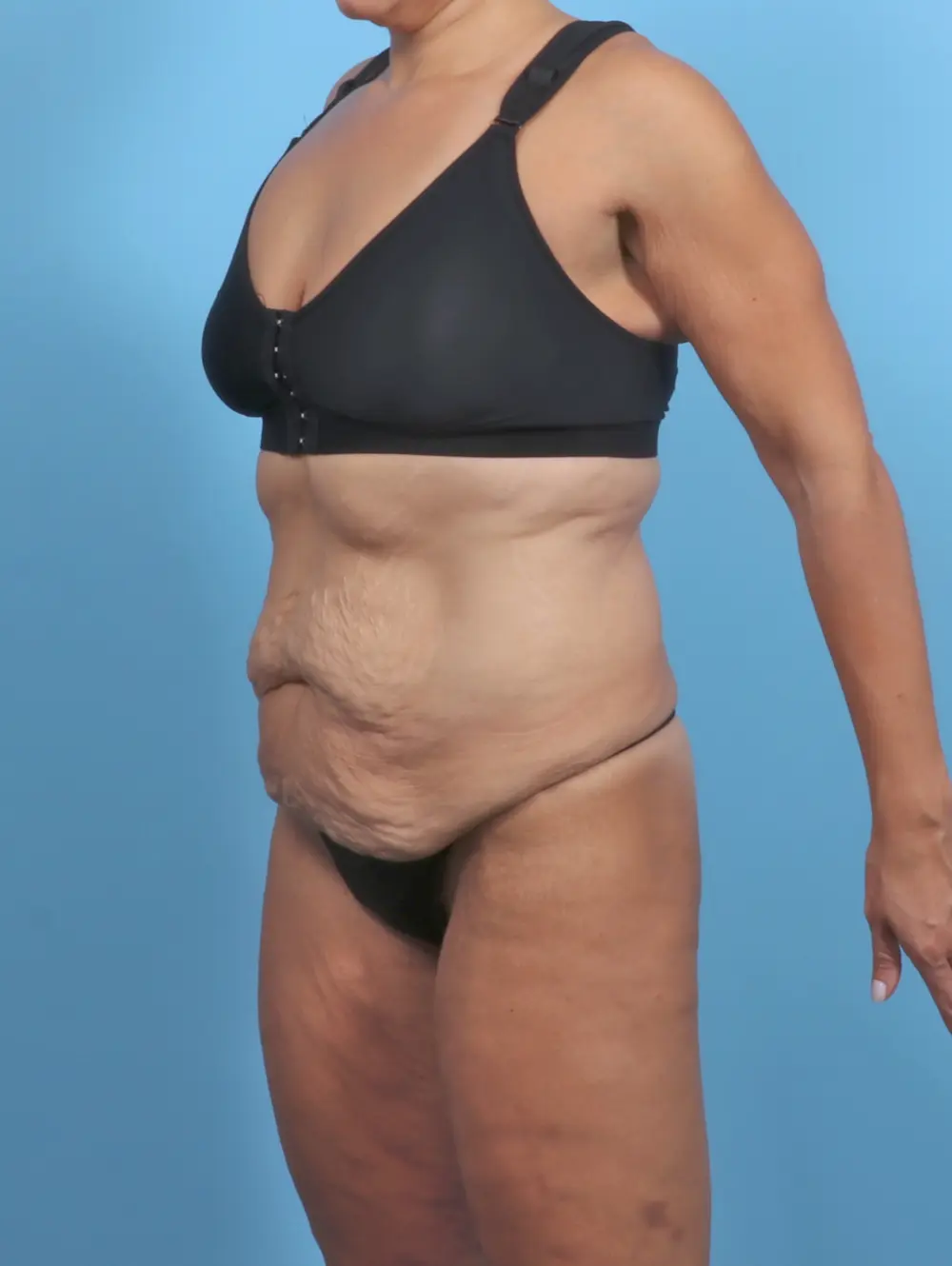 Tummy Tuck Patient Photo - Case 47088 - before view-1