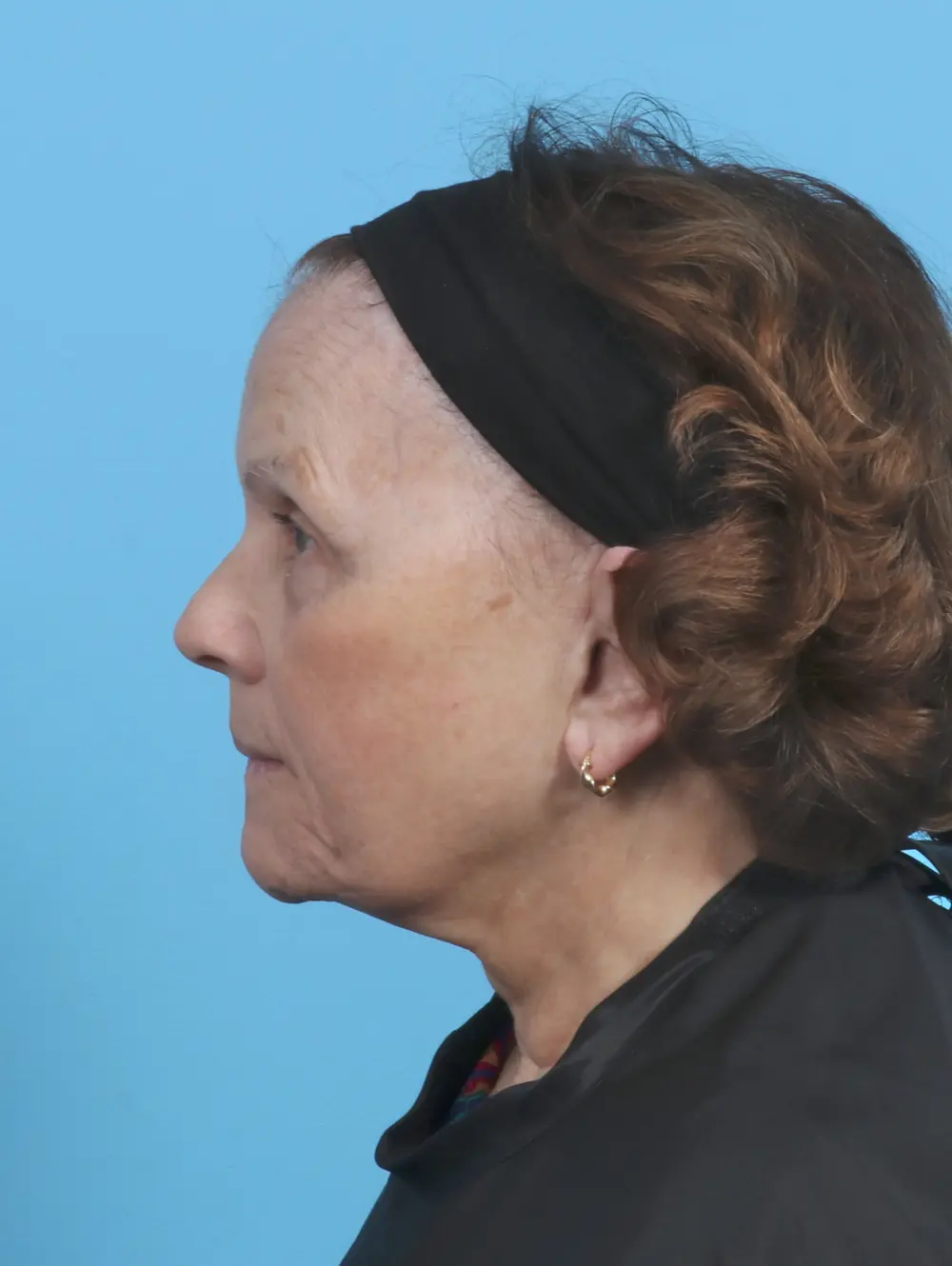 Facelift / Neck Lift Patient Photo - Case 47096 - before view-2