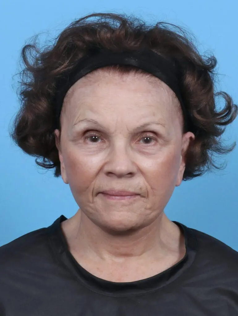 Facelift / Neck Lift - Case 47096 - After
