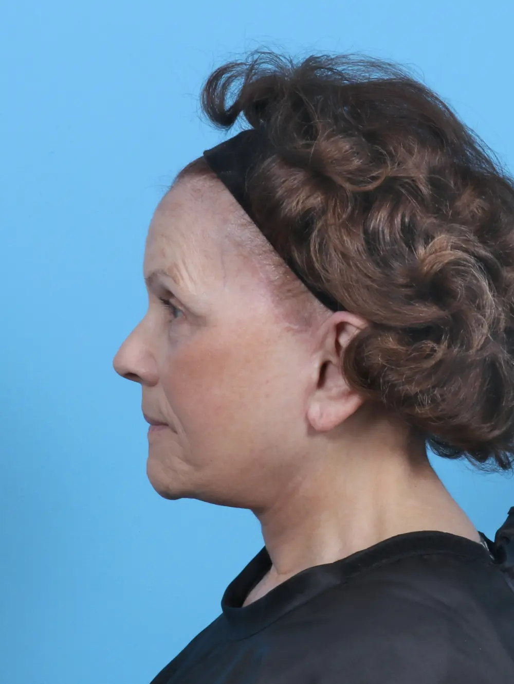 Facelift / Neck Lift Patient Photo - Case 47096 - after view-2