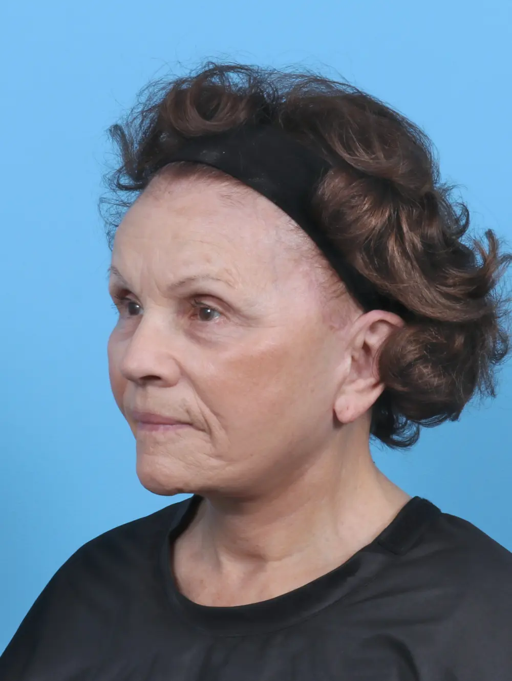 Facelift / Neck Lift Patient Photo - Case 47096 - after view-1