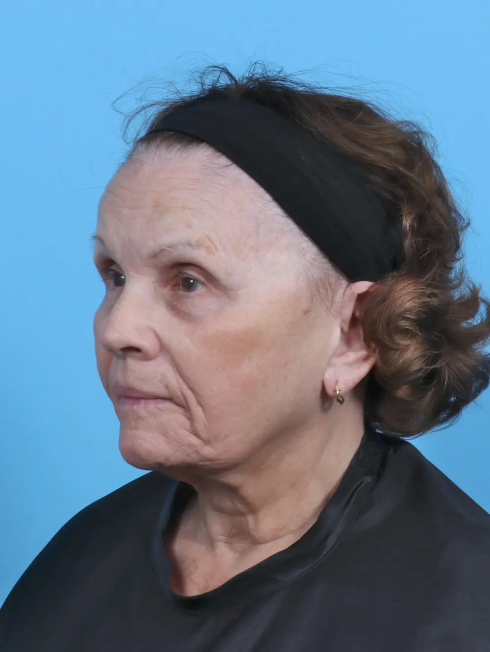 Facelift / Neck Lift Patient Photo - Case 47096 - before view-1