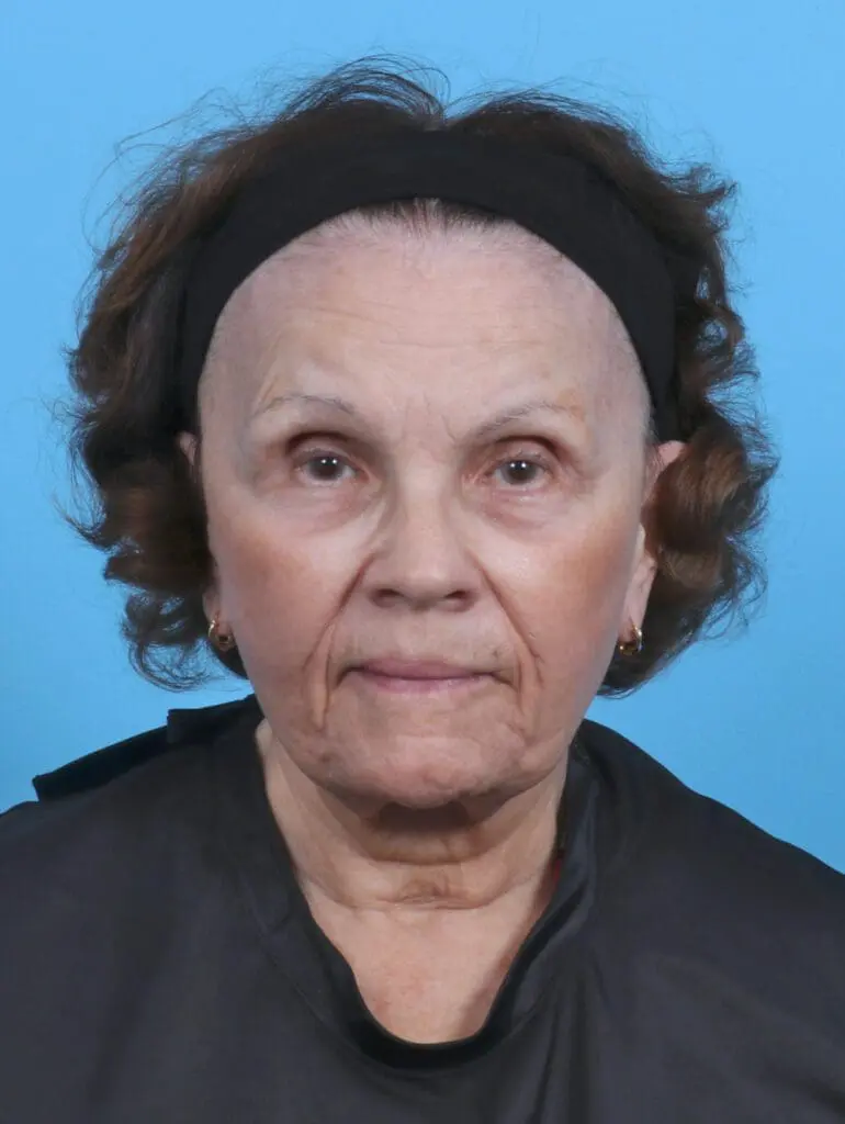 Facelift / Neck Lift - Case 47096 - Before