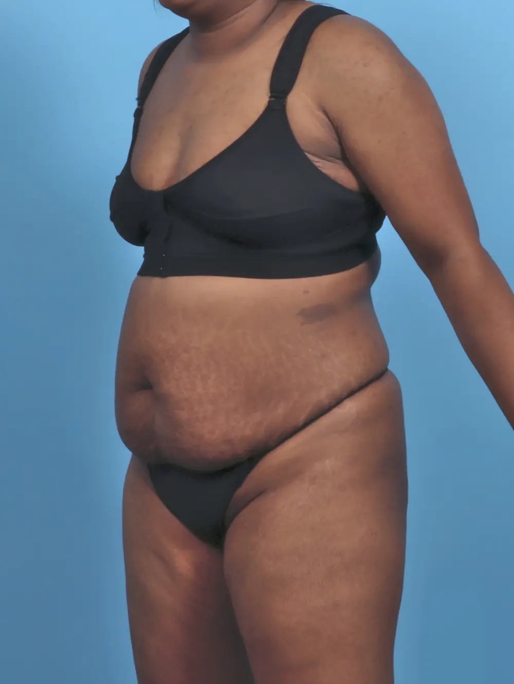 Tummy Tuck Patient Photo - Case 47128 - before view-1