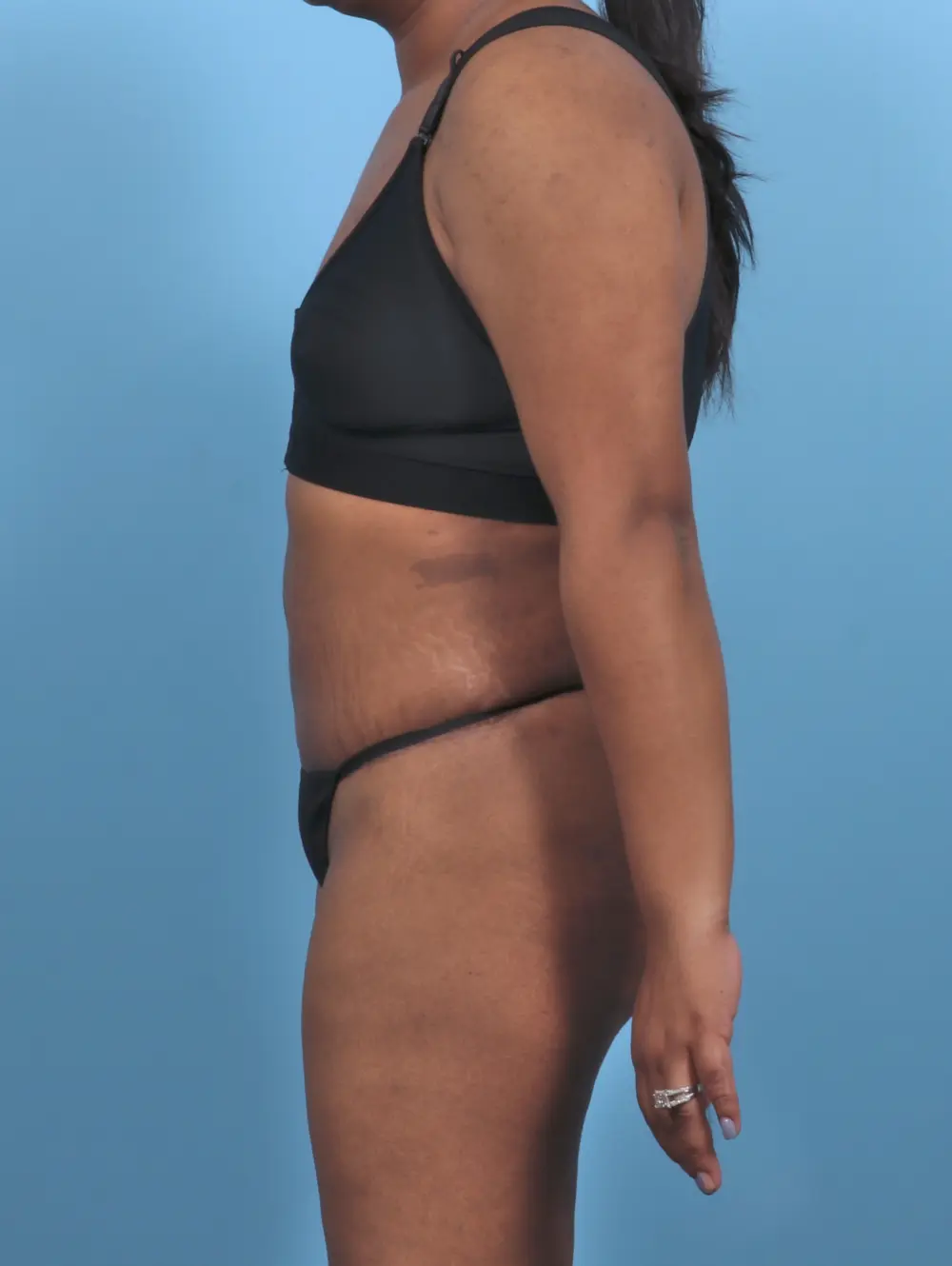 Tummy Tuck Patient Photo - Case 47128 - after view-2