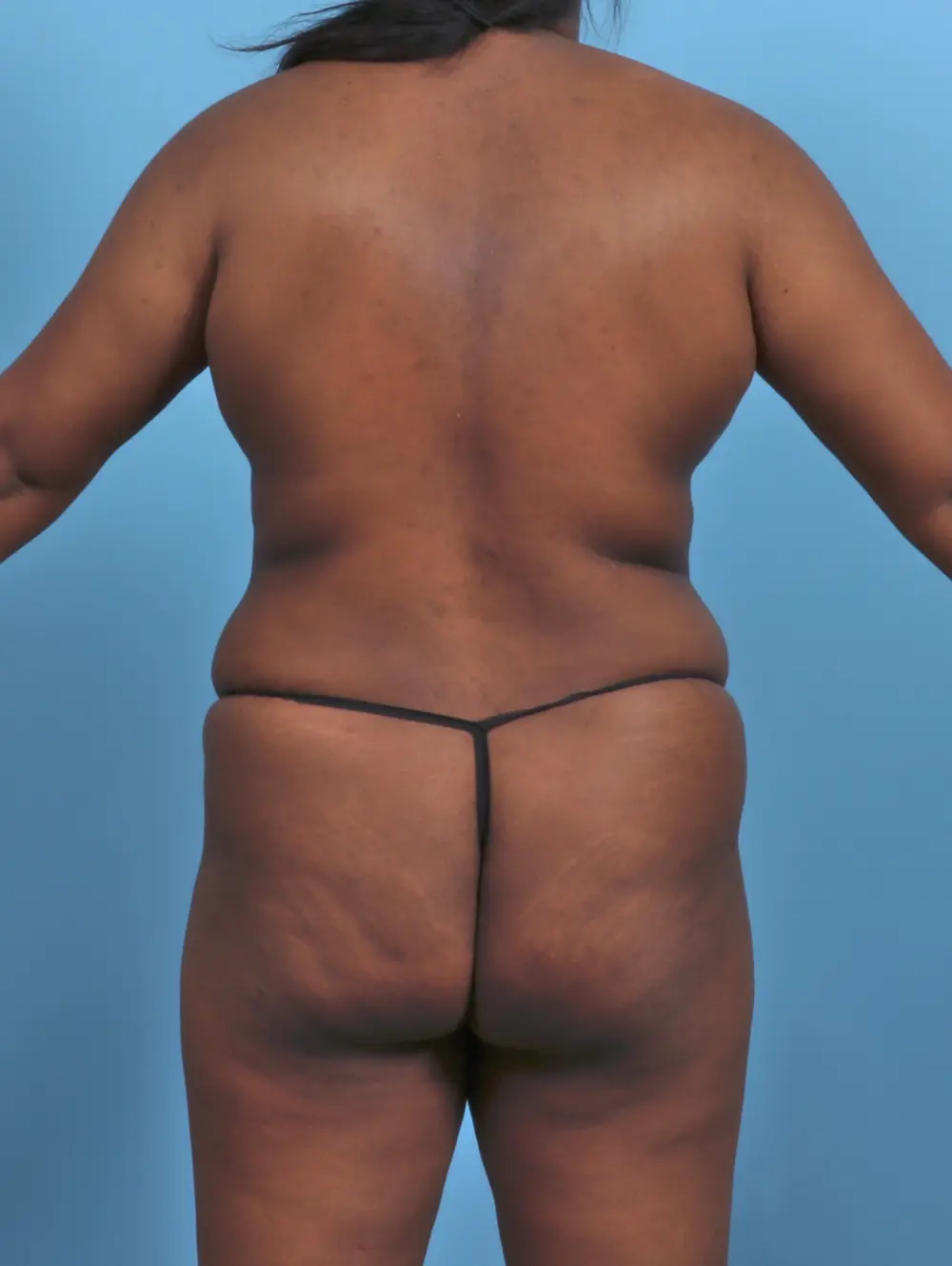 Tummy Tuck Patient Photo - Case 47128 - before view-3