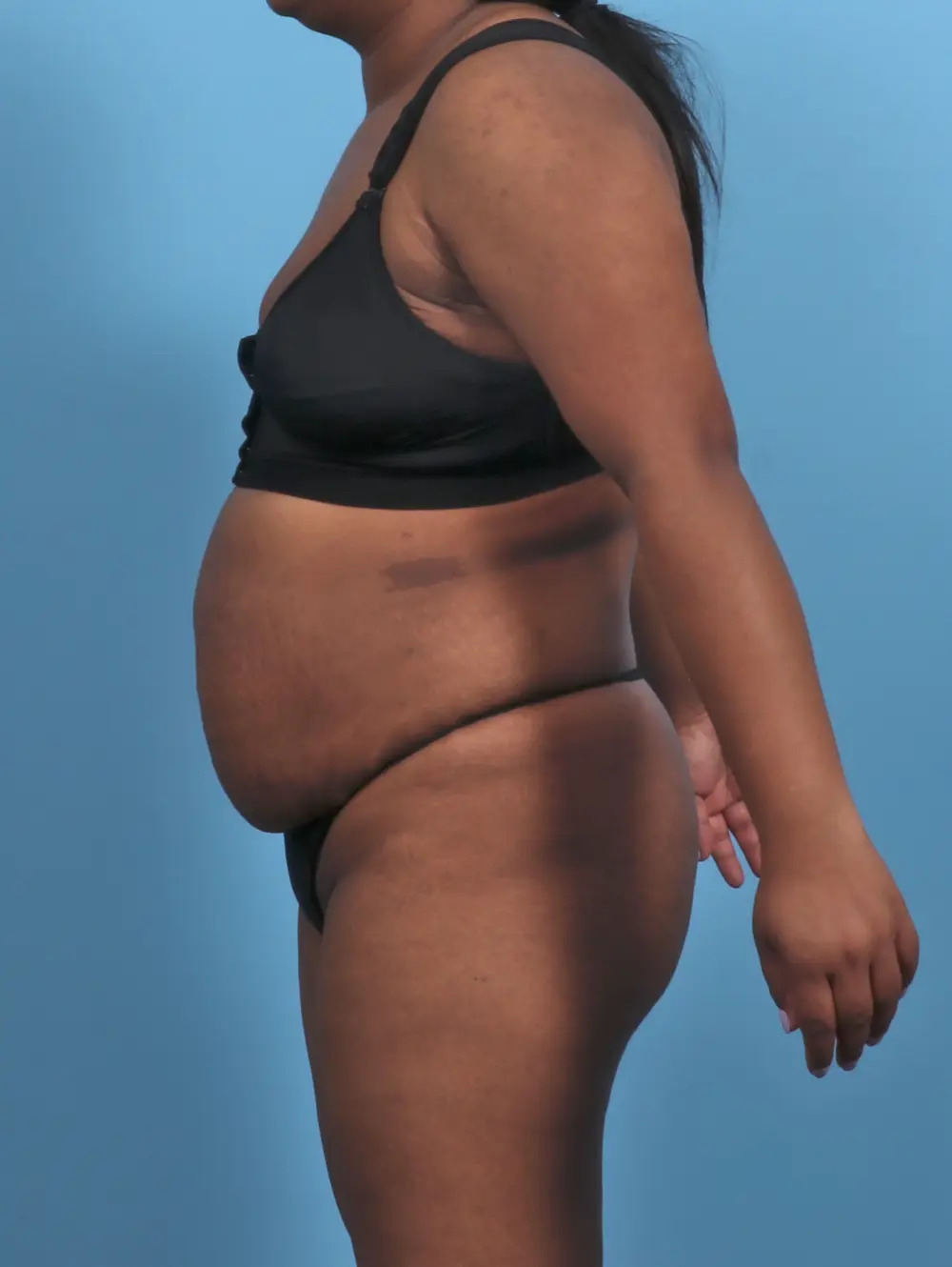 Tummy Tuck Patient Photo - Case 47128 - before view-2
