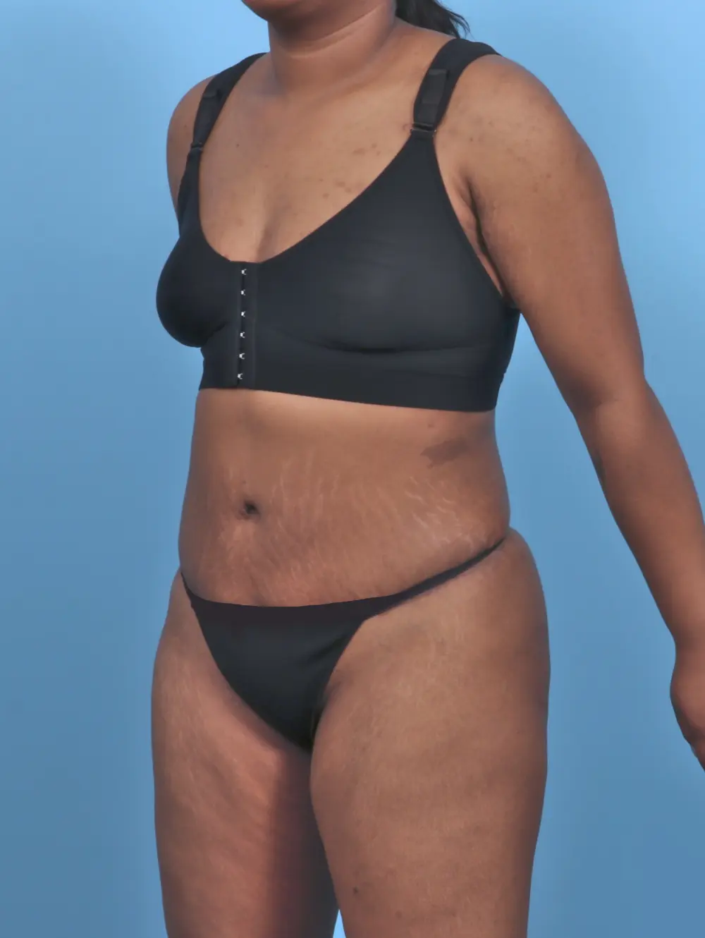 Tummy Tuck Patient Photo - Case 47128 - after view-1