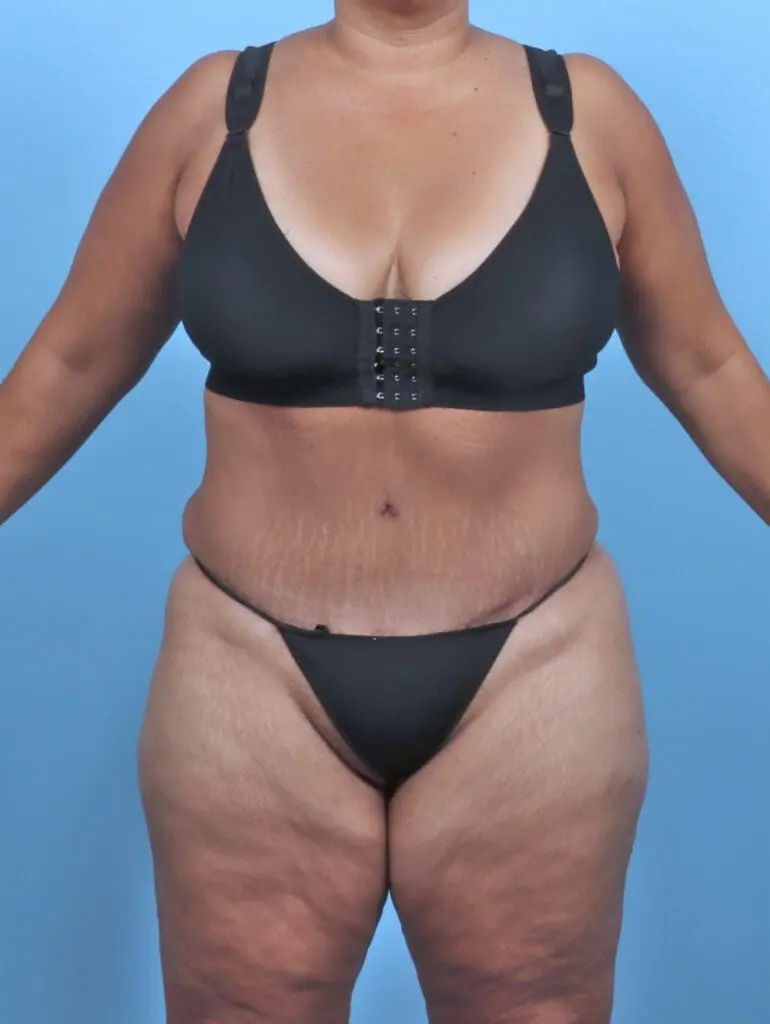 Tummy Tuck - Case 47164 - After