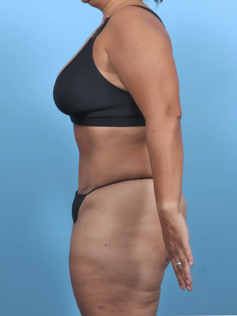 Tummy Tuck Patient Photo - Case 47164 - after view-2