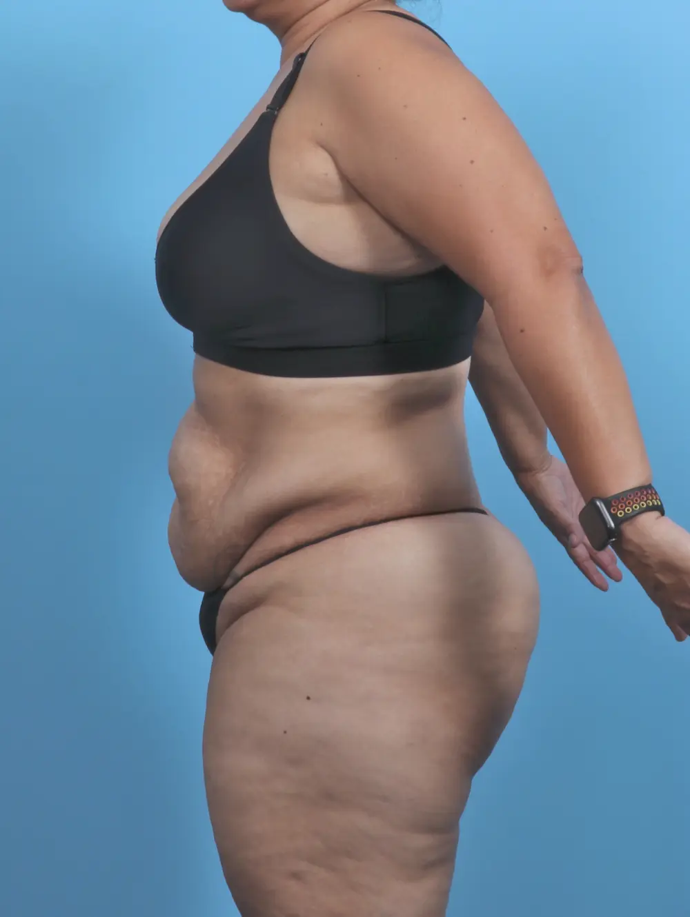 Tummy Tuck Patient Photo - Case 47164 - before view-2