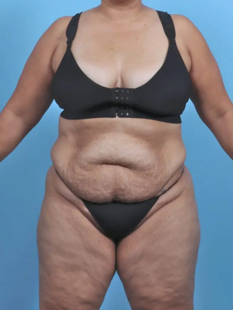 Tummy Tuck - Case 47164 - Before