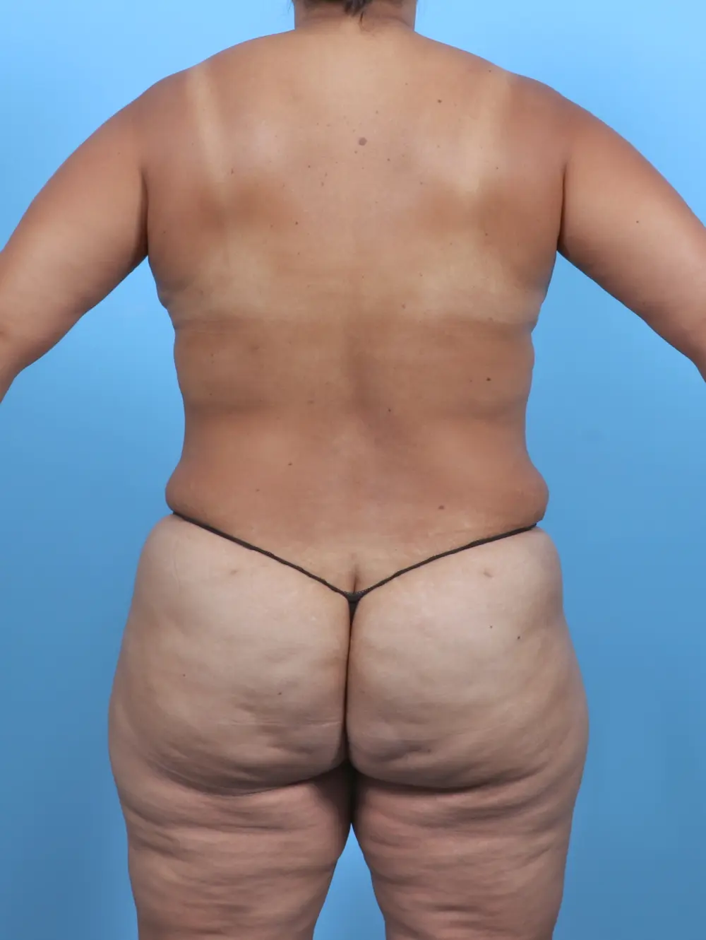 Tummy Tuck Patient Photo - Case 47164 - after view-3