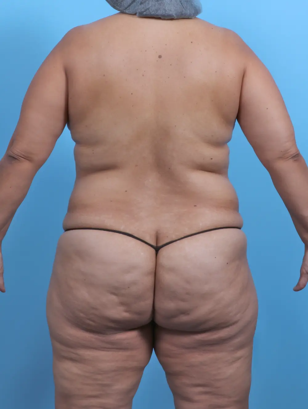 Tummy Tuck Patient Photo - Case 47164 - before view-3