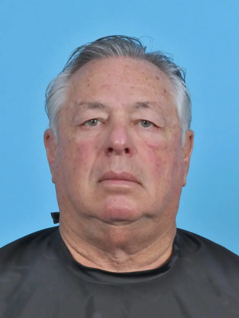 Eyelid Surgery - Case 47184 - Before