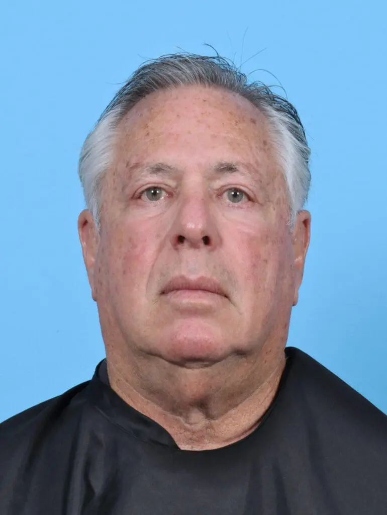 Eyelid Surgery - Case 47184 - After