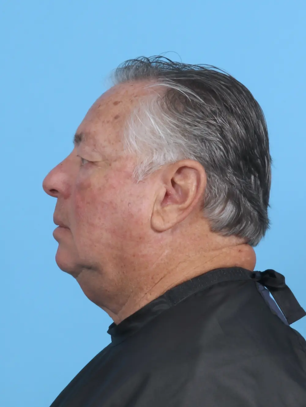 Eyelid Surgery Patient Photo - Case 47184 - before view-2