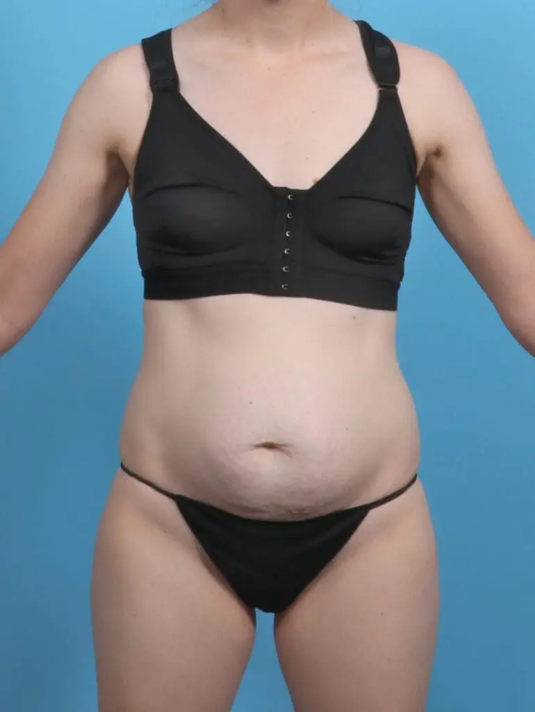 Tummy Tuck - Case 47192 - Before