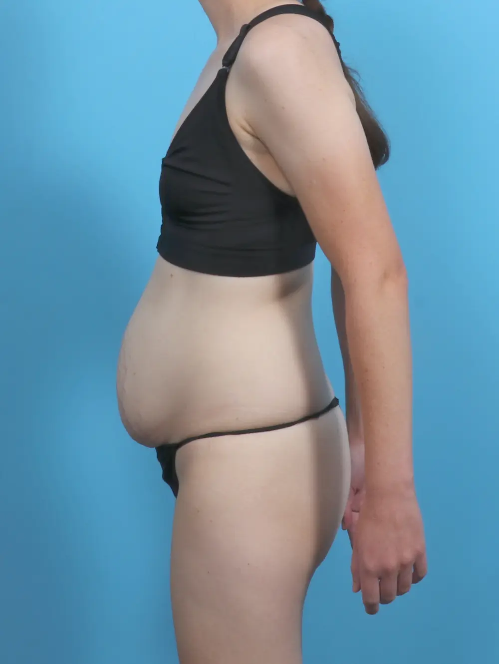 Tummy Tuck Patient Photo - Case 47192 - before view-2