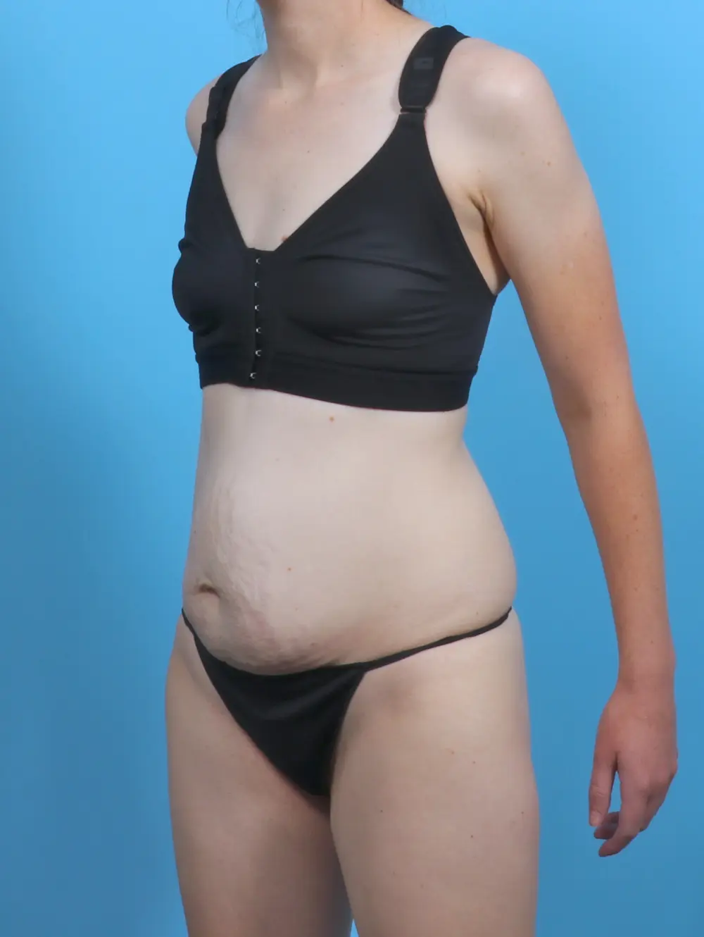 Tummy Tuck Patient Photo - Case 47192 - before view-1