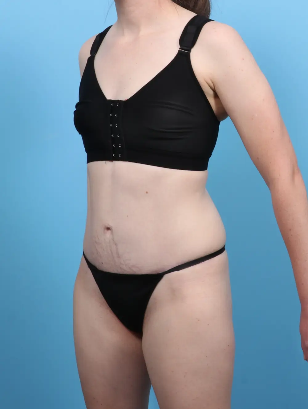 Tummy Tuck Patient Photo - Case 47192 - after view-1