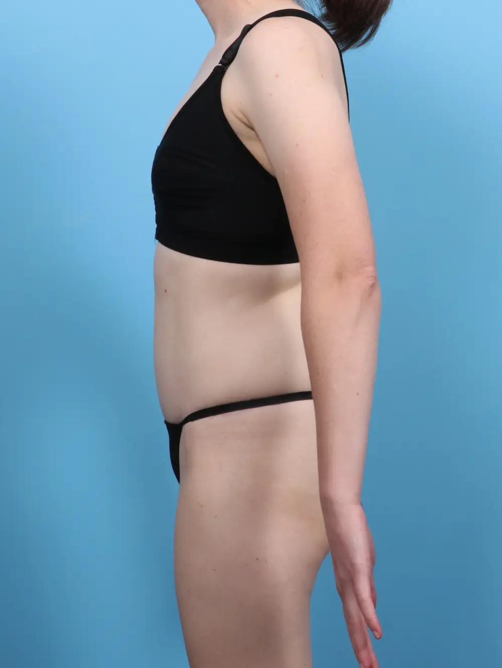Tummy Tuck Patient Photo - Case 47192 - after view-2